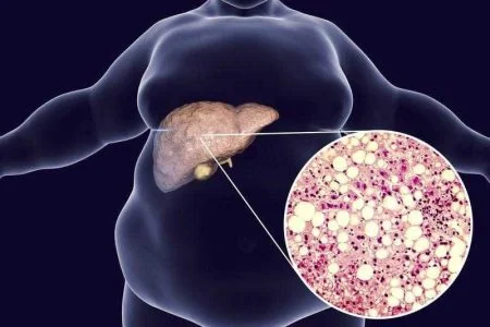 طب سنتی | کبد چرب طب سنتی برای کبد چرب گرید 2