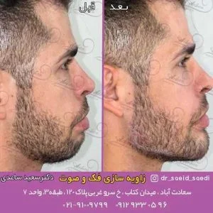 هزینه کانتورینگ صورت چقدر است