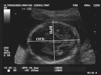 اندازه نرمال سر جنین bpd در سونوگرافی چقدر است؟