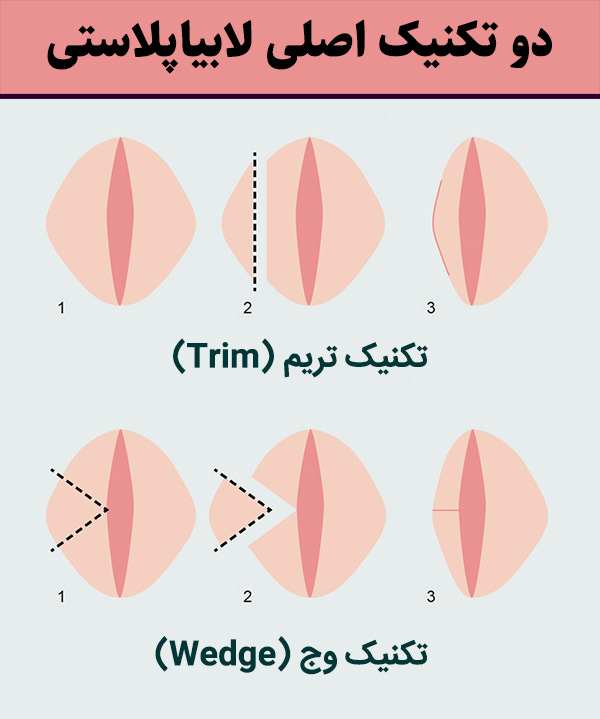 دوران نقاهت لابیاپلاستی